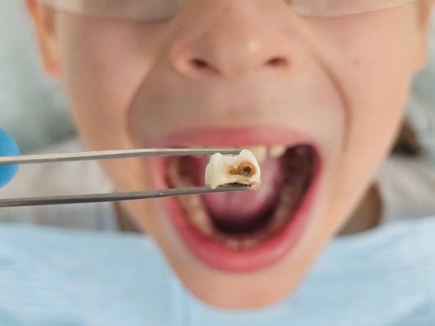 Best Emergency Treatment for Oral Infections in Greenacres, CA